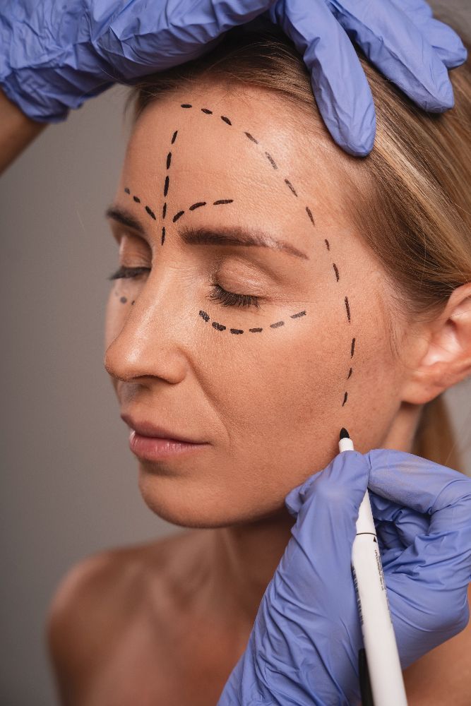 Surgical Face Lift