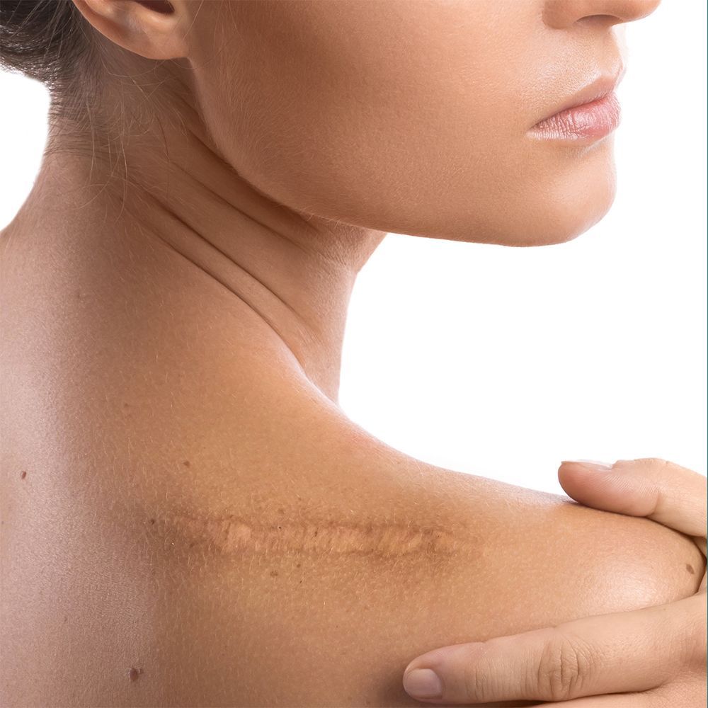 Scar Revision