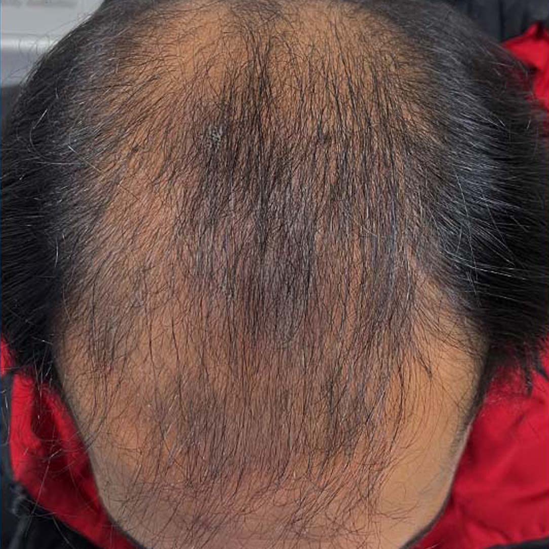 hair transplant before and after result in peshawar