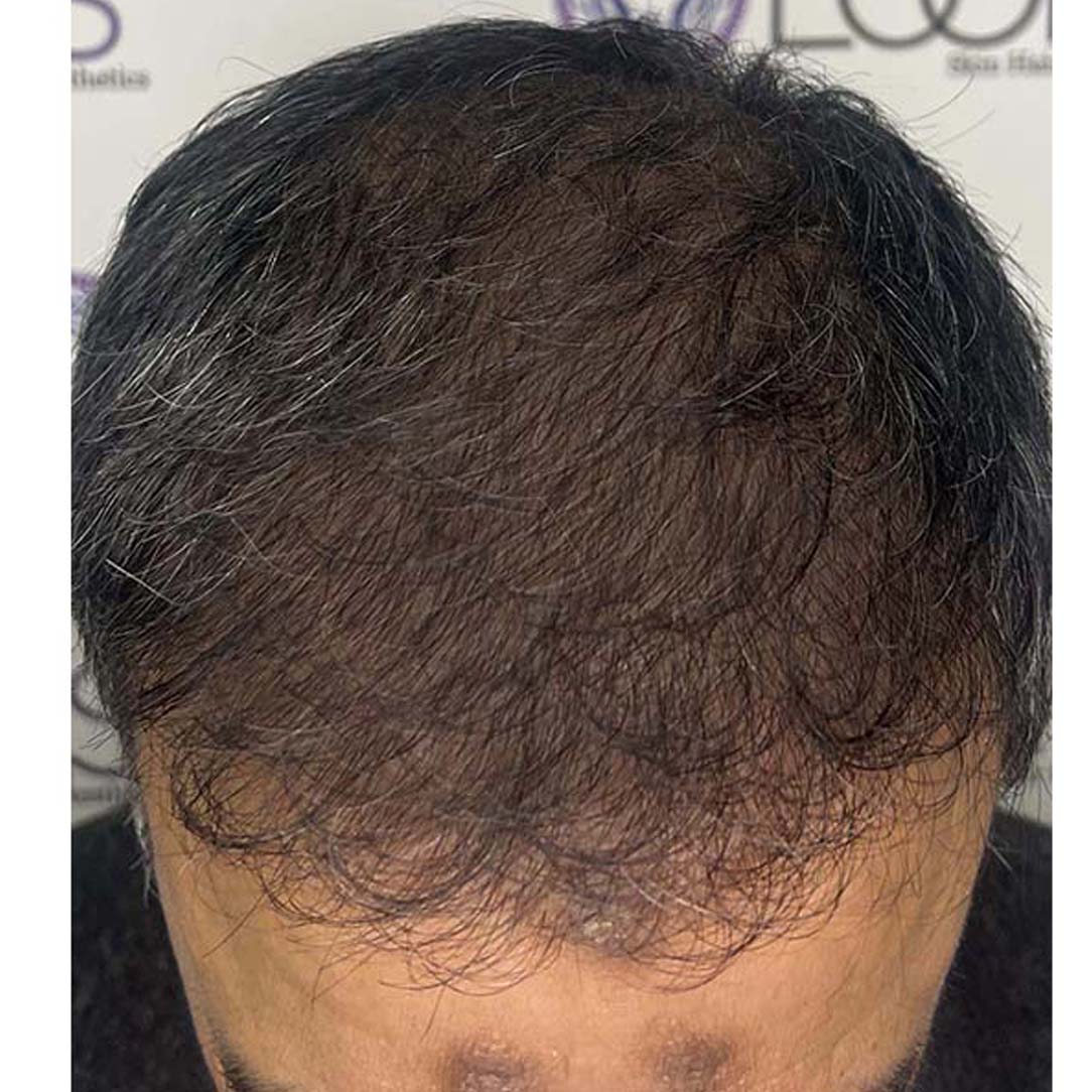 hair transplant before and after result in peshawar