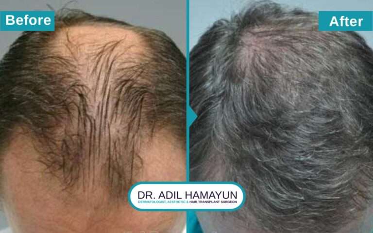 Hair Restoration