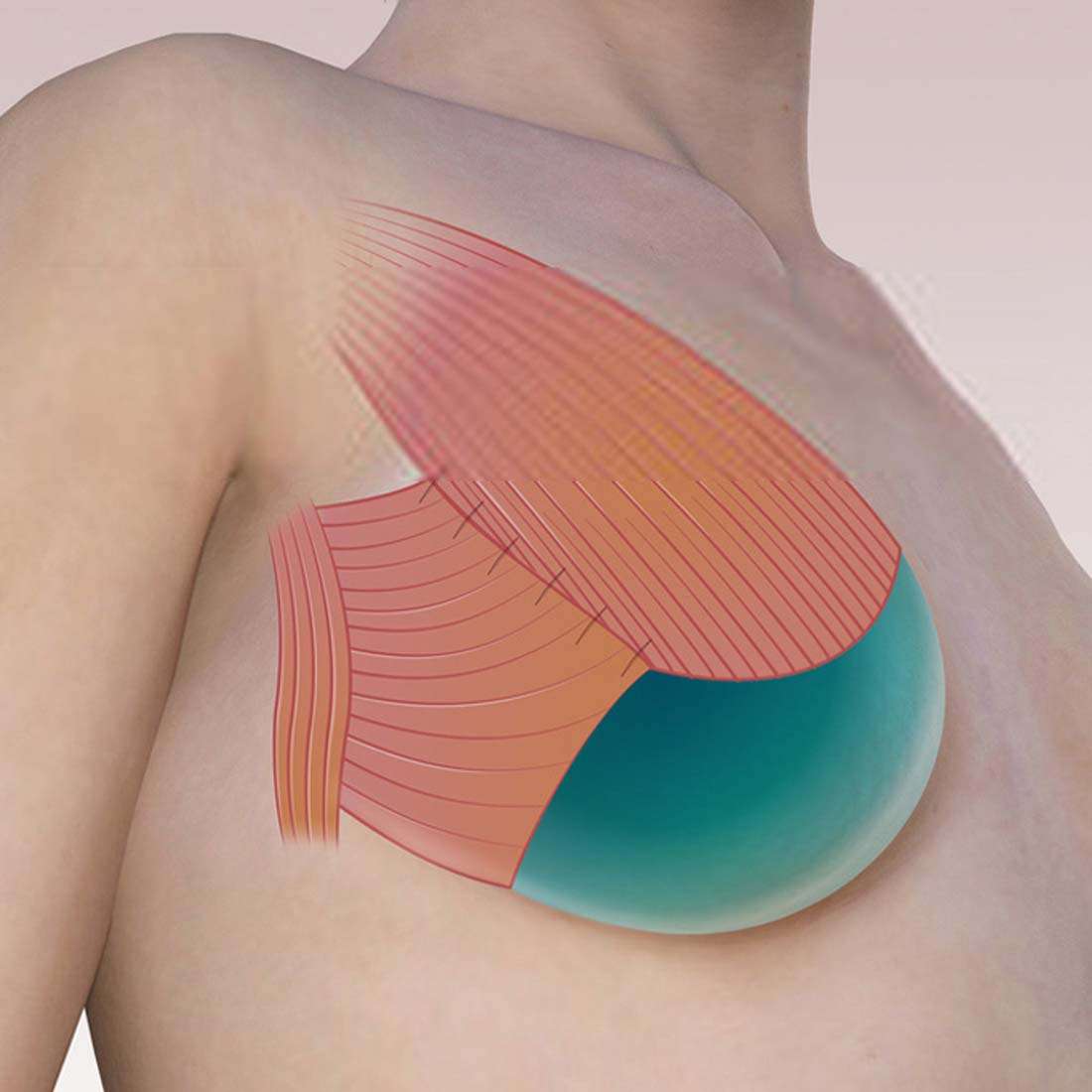 Breast Reconstruction