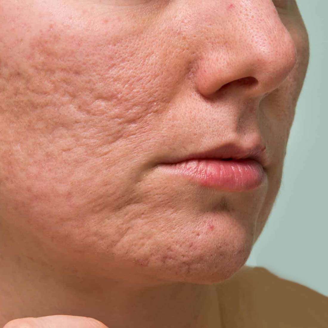 Fat Grafting For Acne Scars