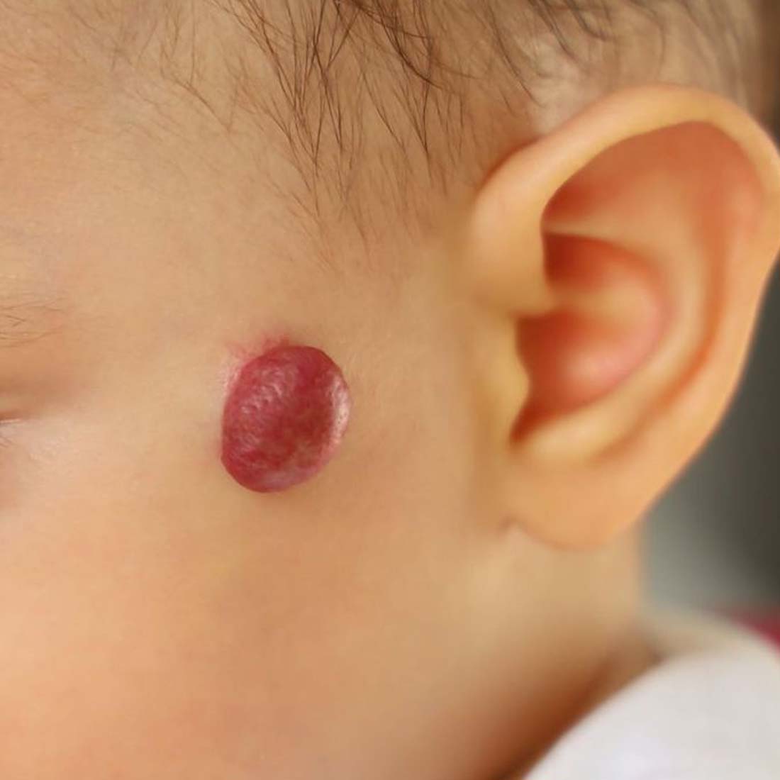 hemangiomas Treatment