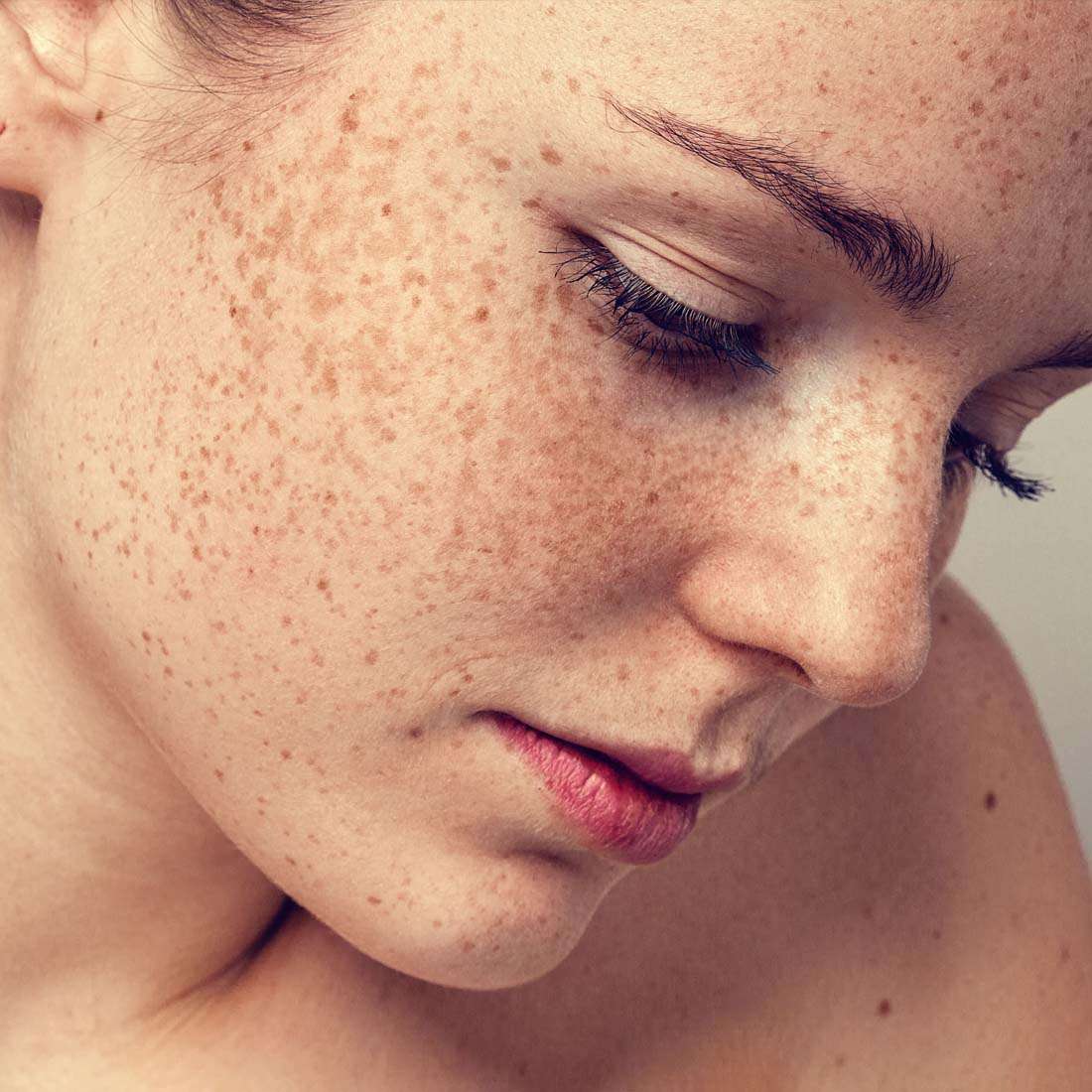 Freckles Removal Treatment