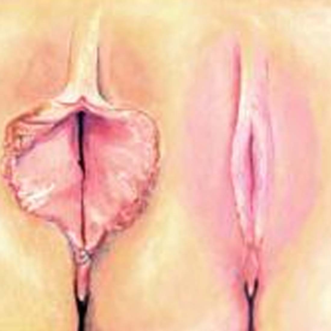 Labiaplasty treatment