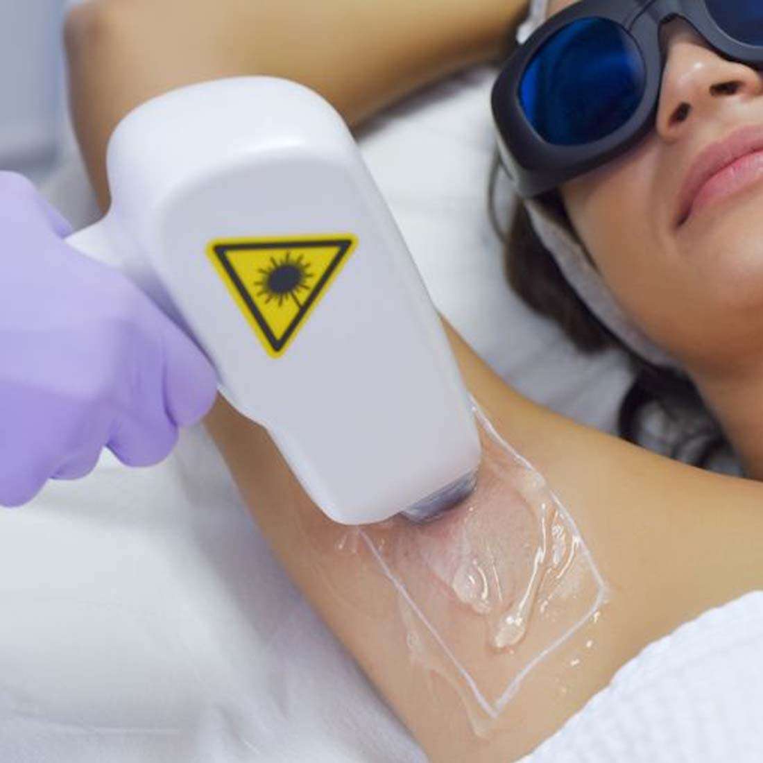 Laser Hair Removal