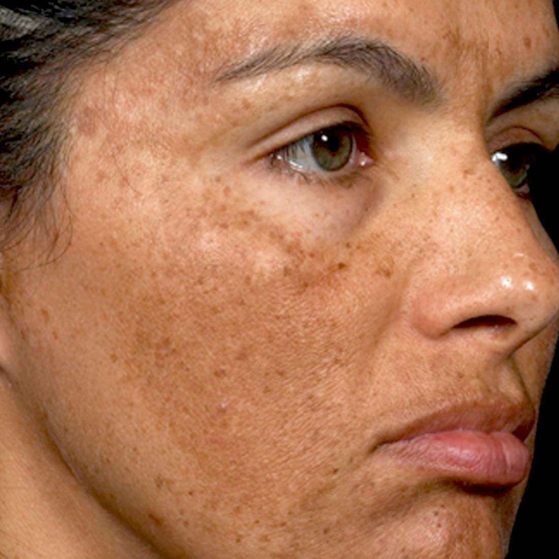 Melasma Hyperpigmentation