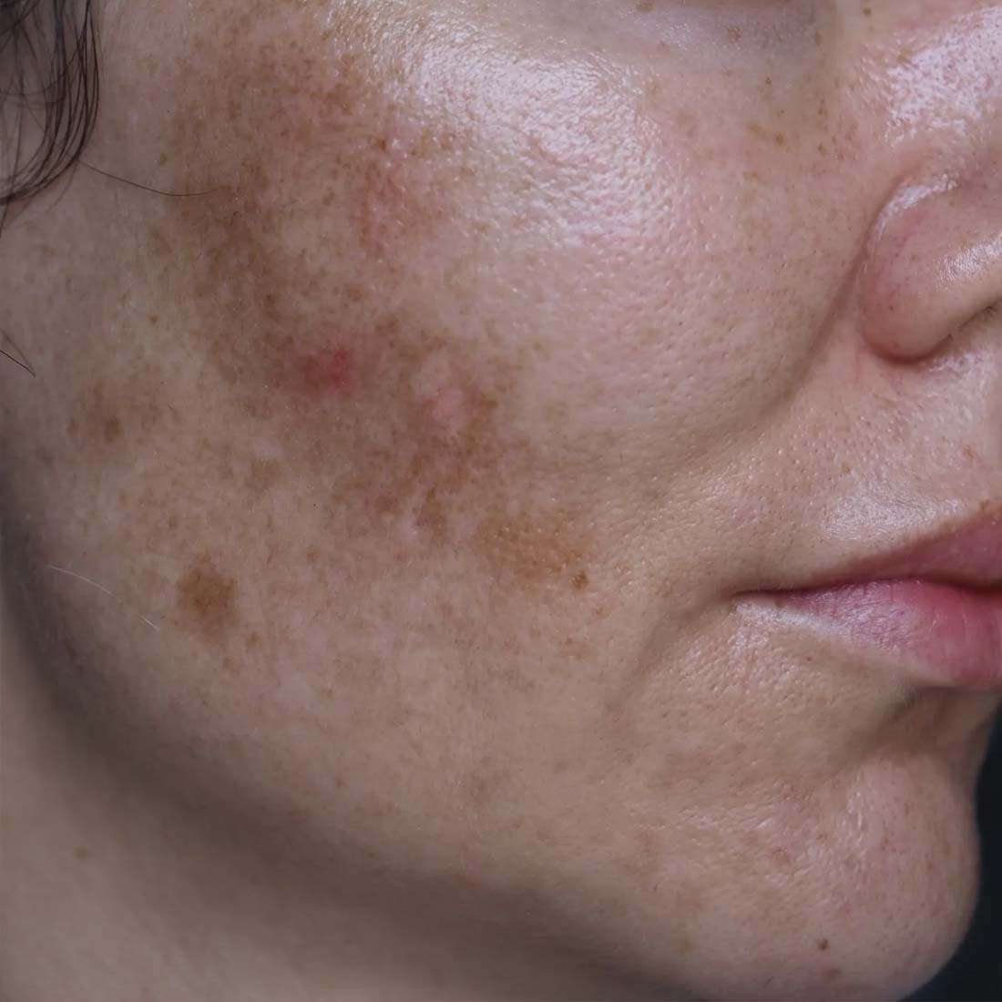 Melasma Treatment