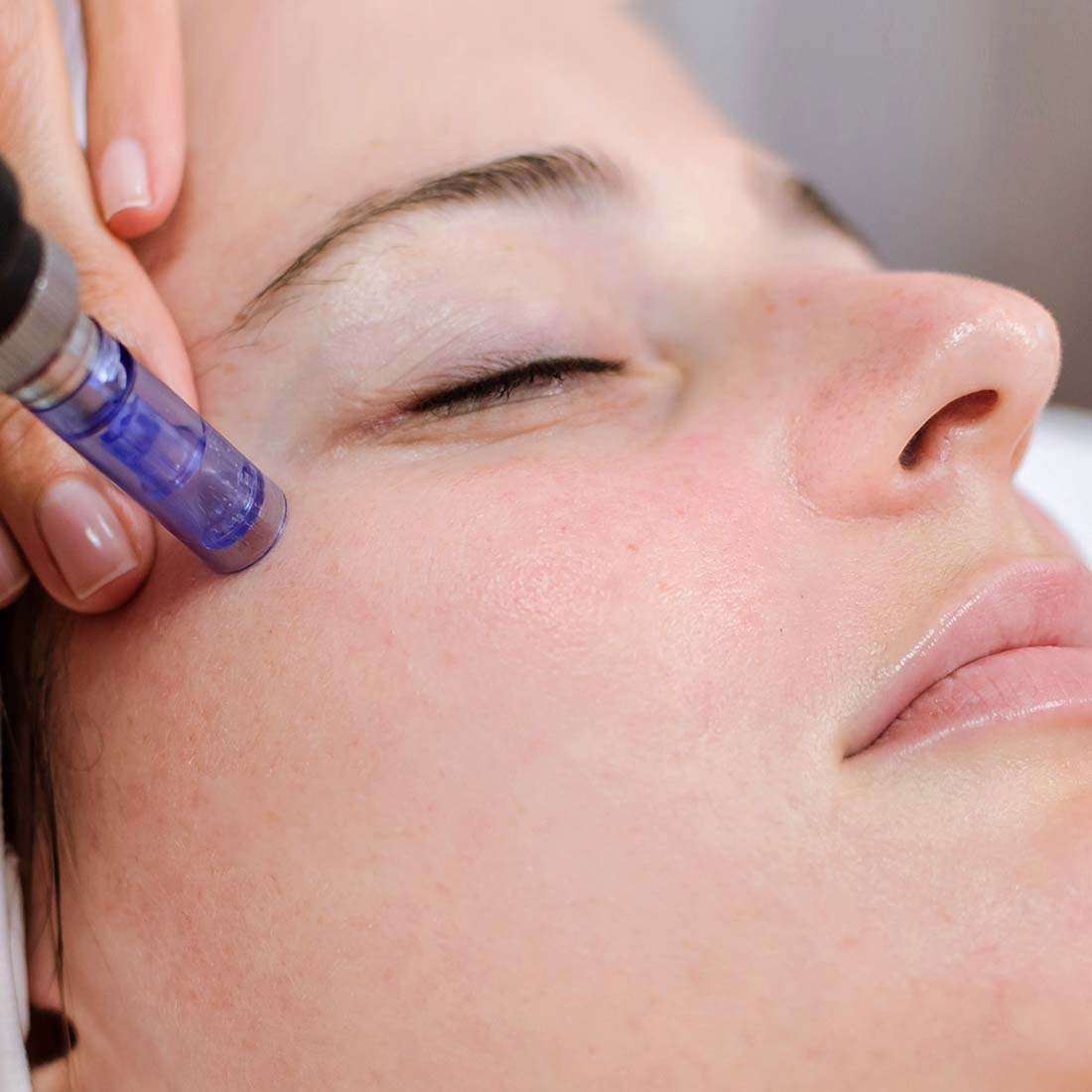 Microneedling for acne scars