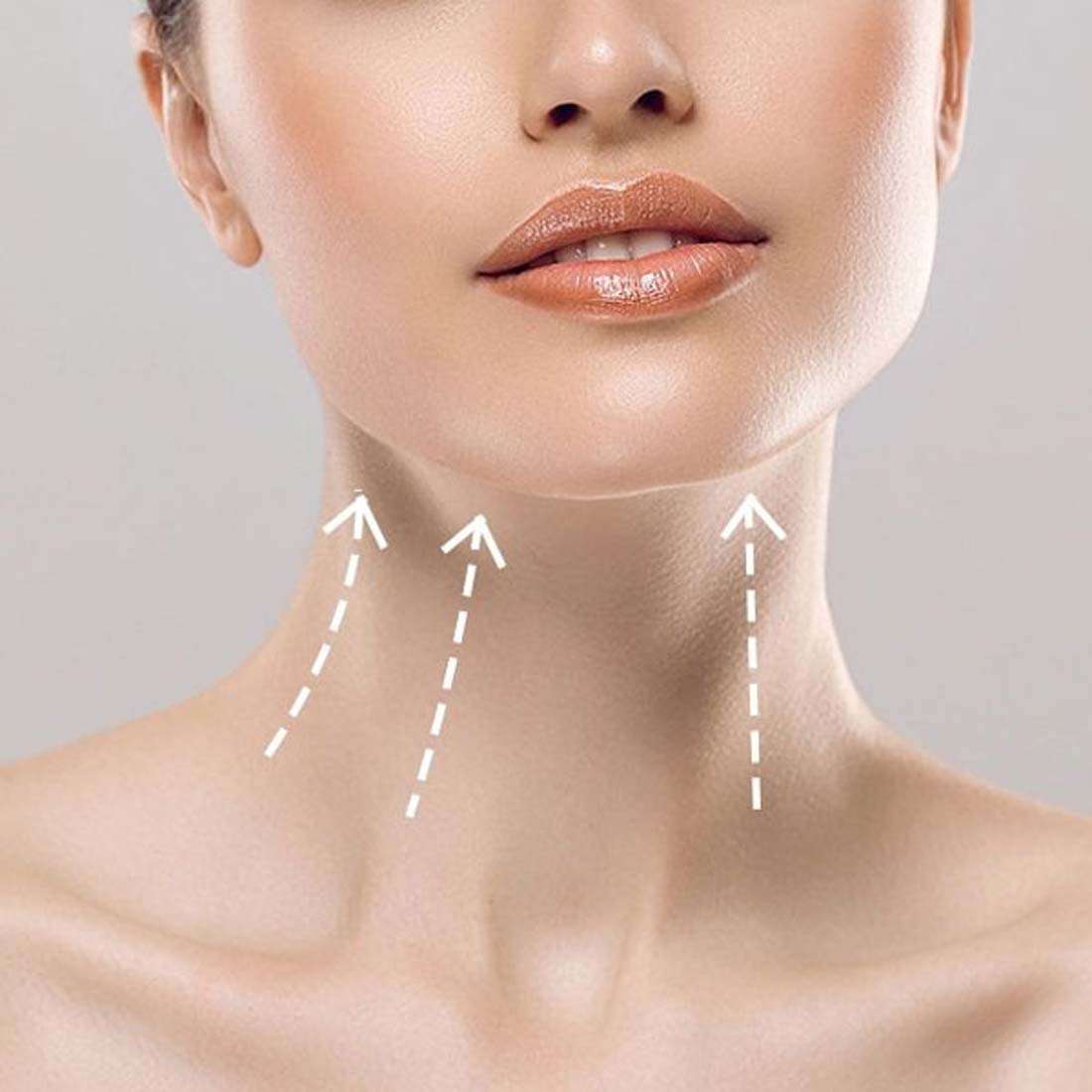 Neck Lift Treatment