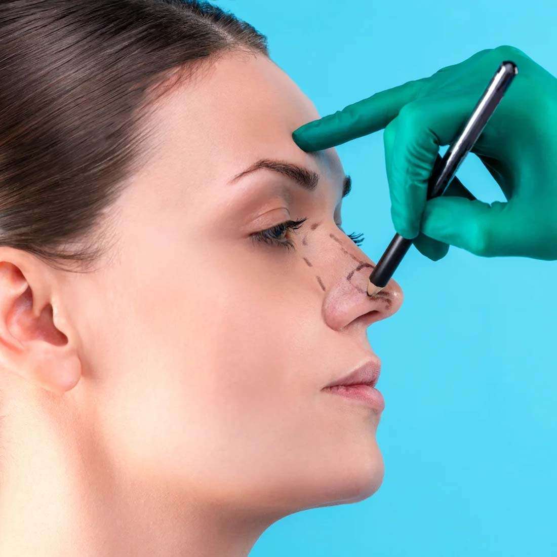 Nose Reshaping Rhinoplasty