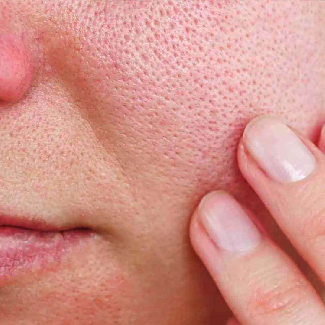 Open Pores Treatment