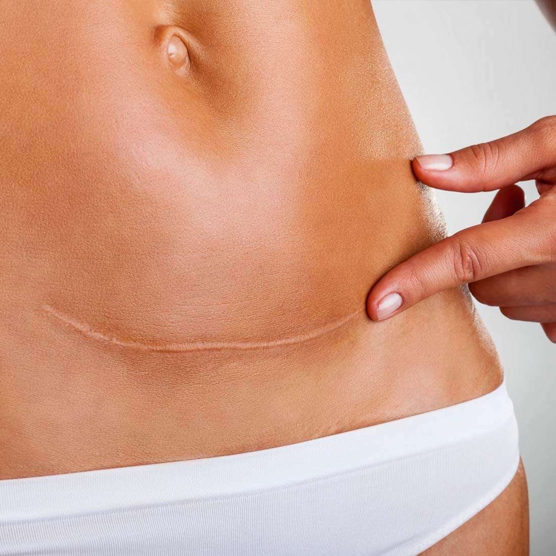 Post Surgical Scars Treatment