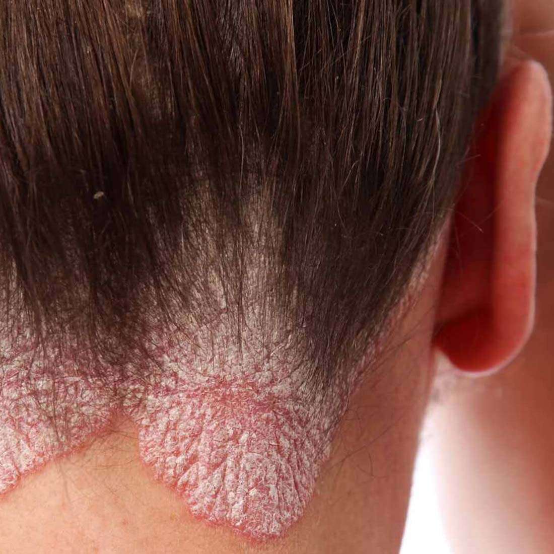 Psoriasis Treatment