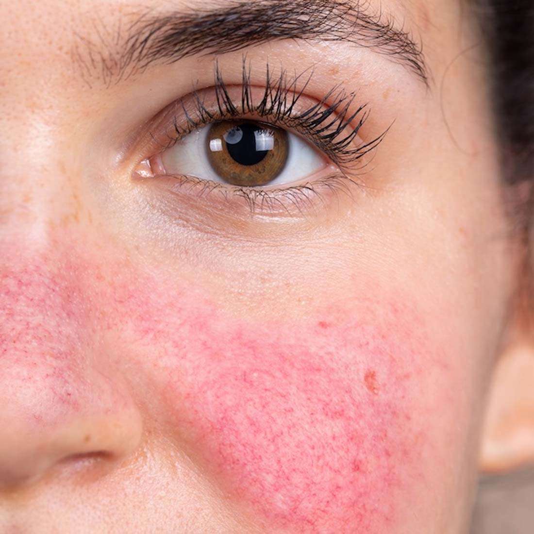 Rosacea Treatment In Peshawar & Islamabad