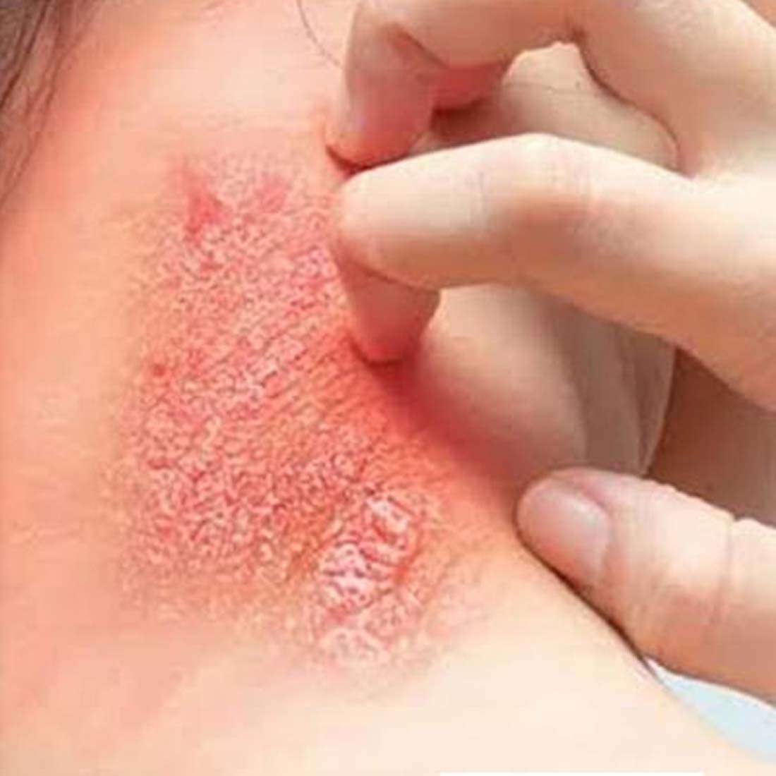 Skin Infection Treatment