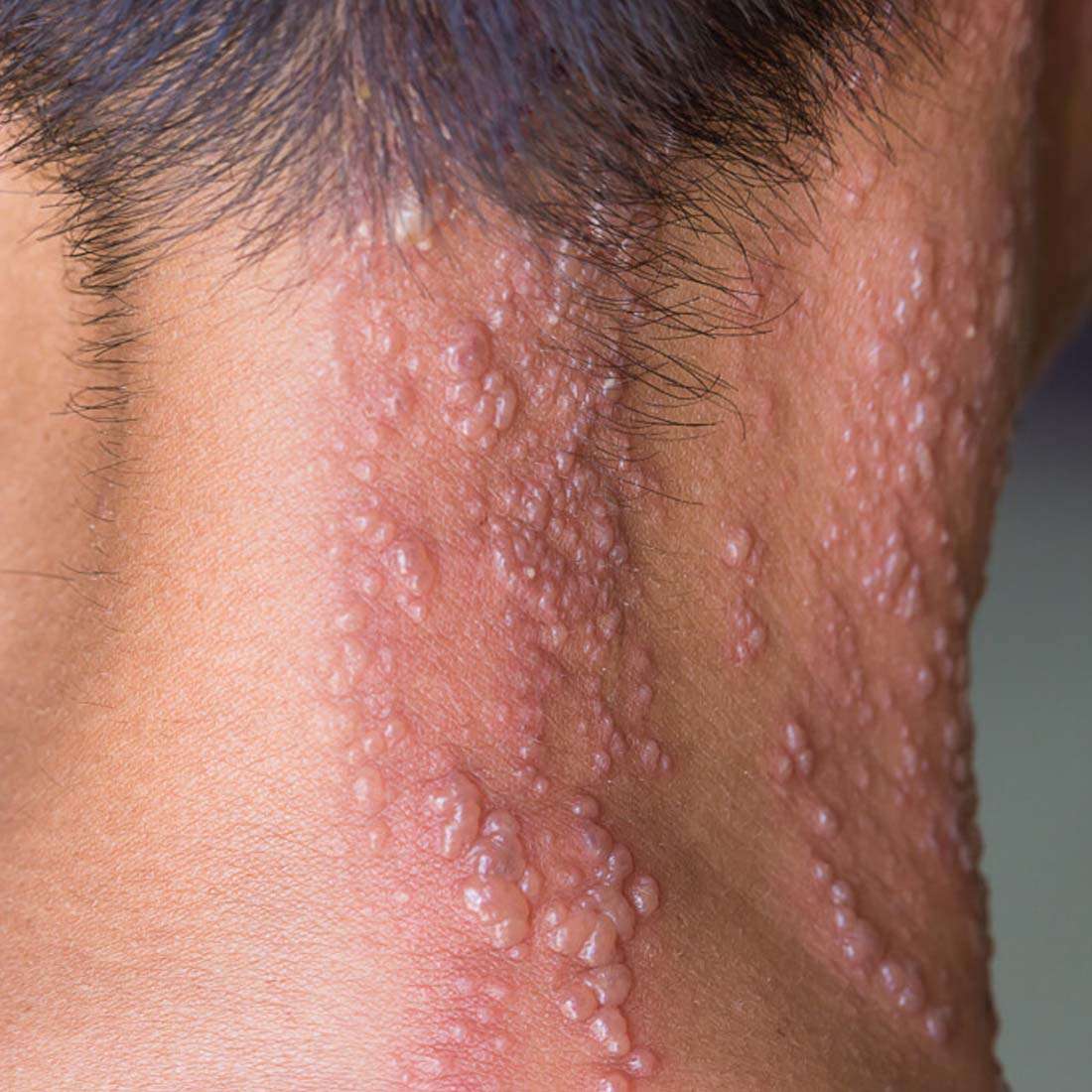 Skin Shingles Treatment In Peshawar & Islamabad