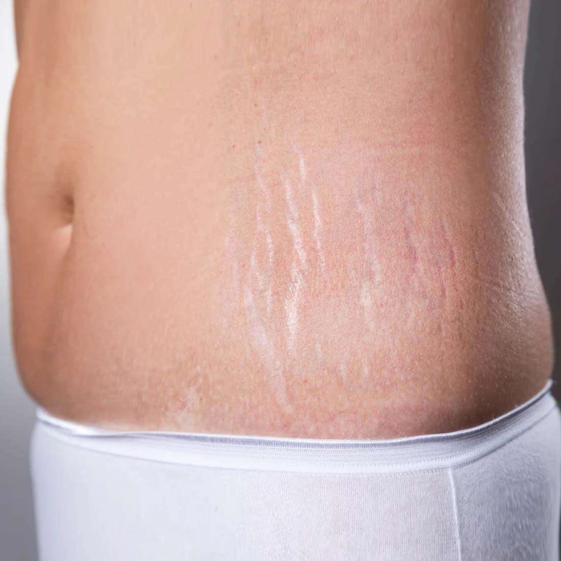 Stretch Marks Reduction