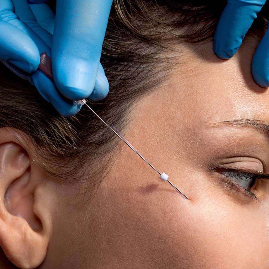 Thread Lift Treatment In Peshawar And Islamabad