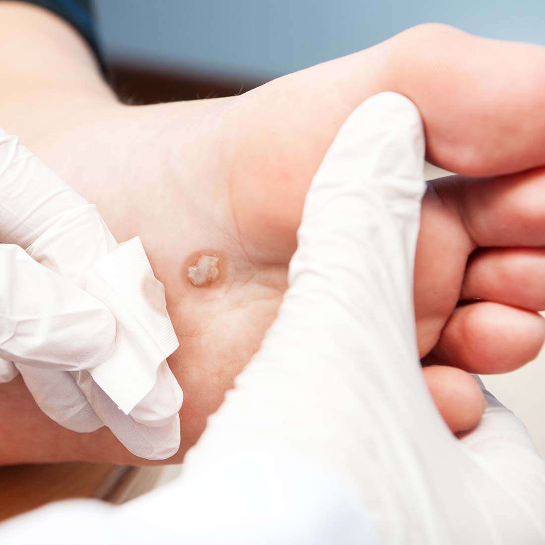 Wart Removal Treatment In Peshawar & Islamabad