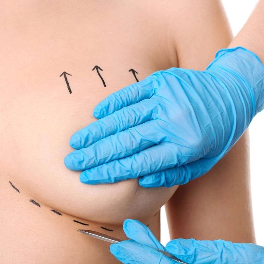 Breast Augmentation