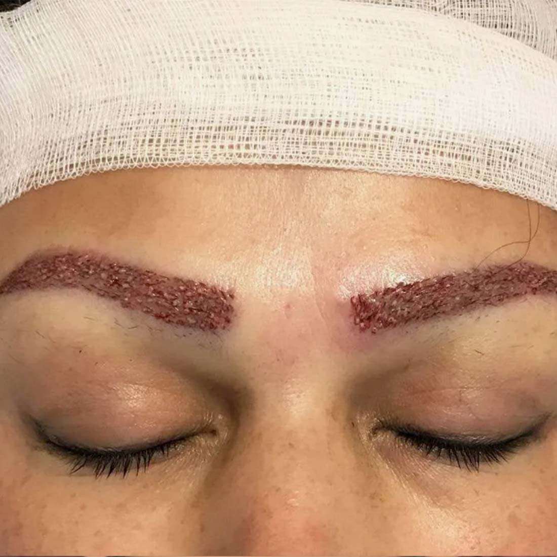 FUE Eyebrow Transplant