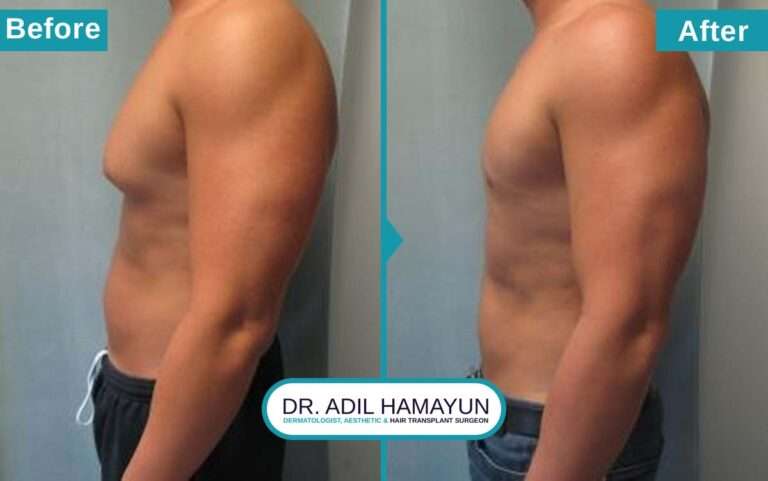 Gynecomastia Treatment