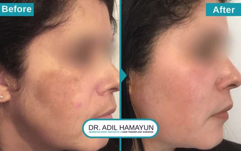 Melasma Removal Treatment