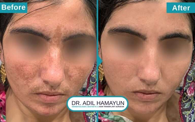 Melasma Removal Treatment