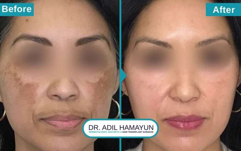 Melasma Removal Treatment