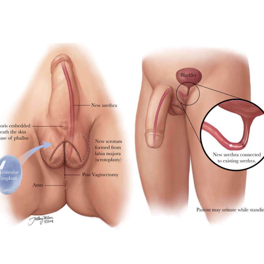 Phalloplasty in Peshawar with Dr. Adil Hamayun