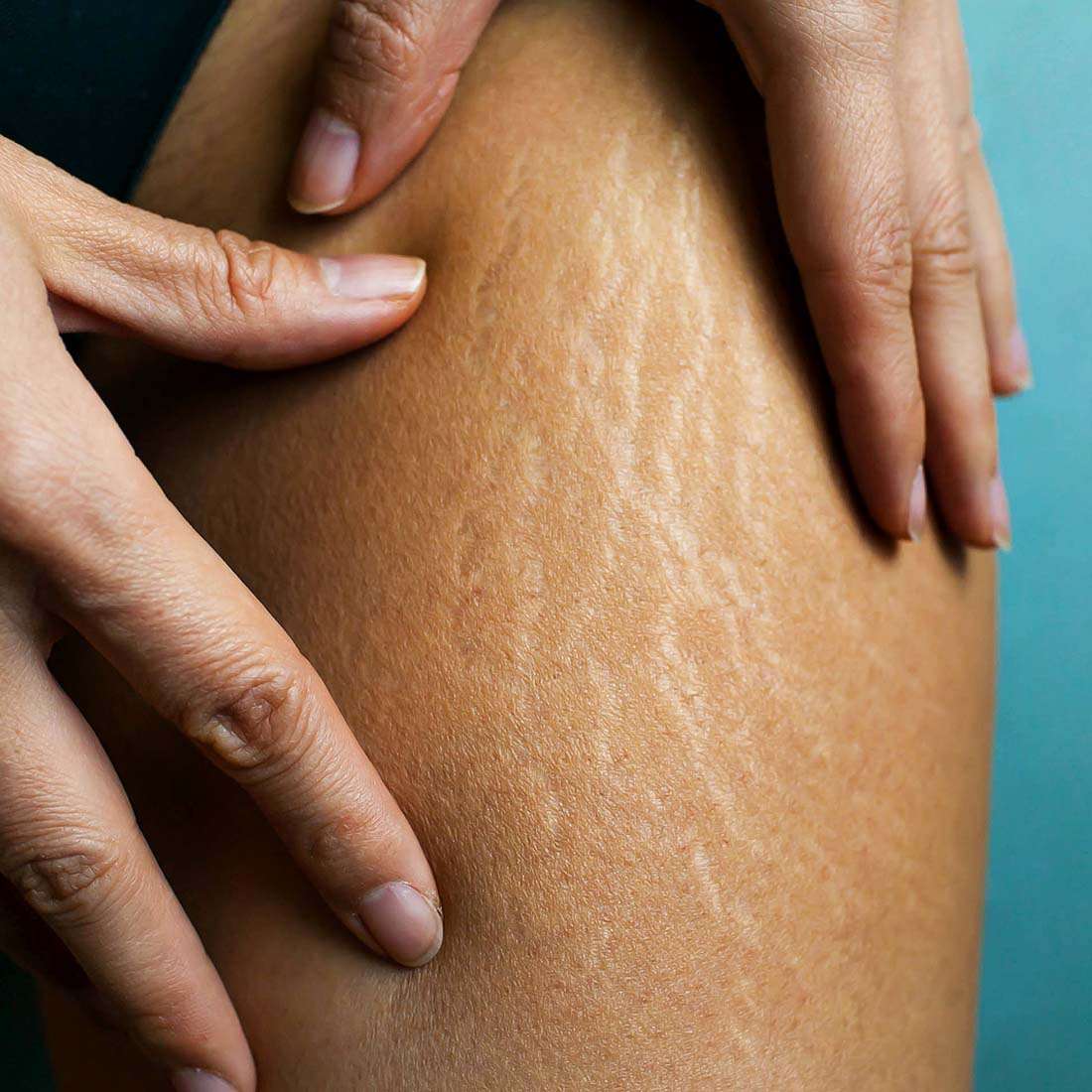 Stretch Mark Treatment