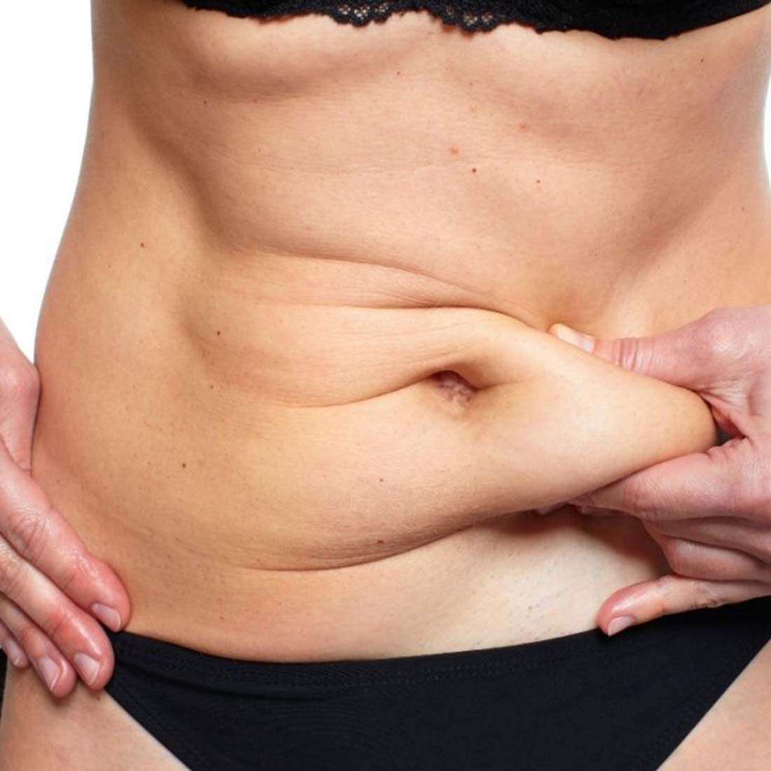 tummy tuck abdominoplasty