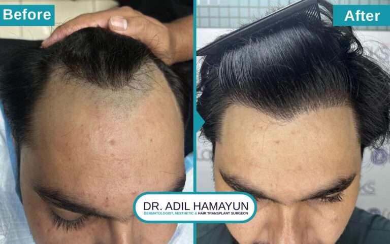 Best Unshaved Hair Transplant in Peshawar & Islamabad