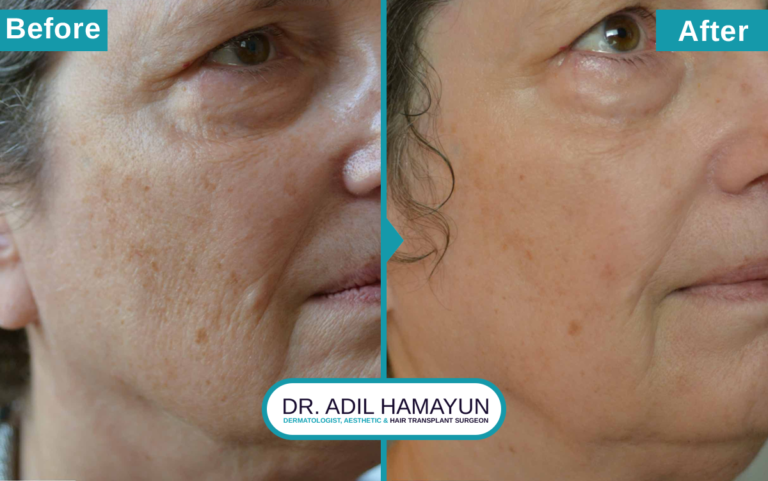 Best CO2 Laser resurfacing Treatment in Peshawar