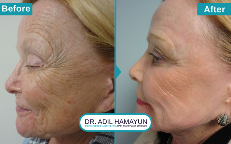 Best CO2 Laser resurfacing Treatment in Peshawar