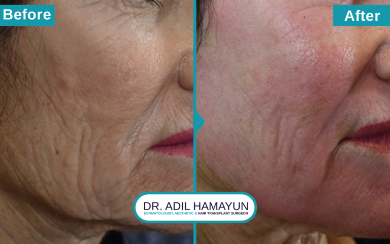 Best CO2 Laser resurfacing Treatment in Peshawar