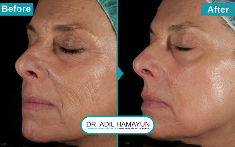 Best CO2 Laser resurfacing Treatment in Peshawar