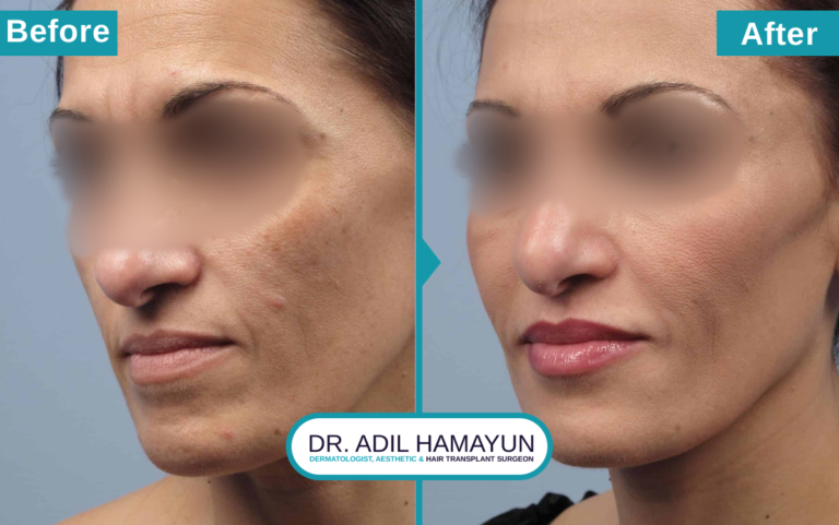 Best CO2 Laser resurfacing Treatment in Peshawar