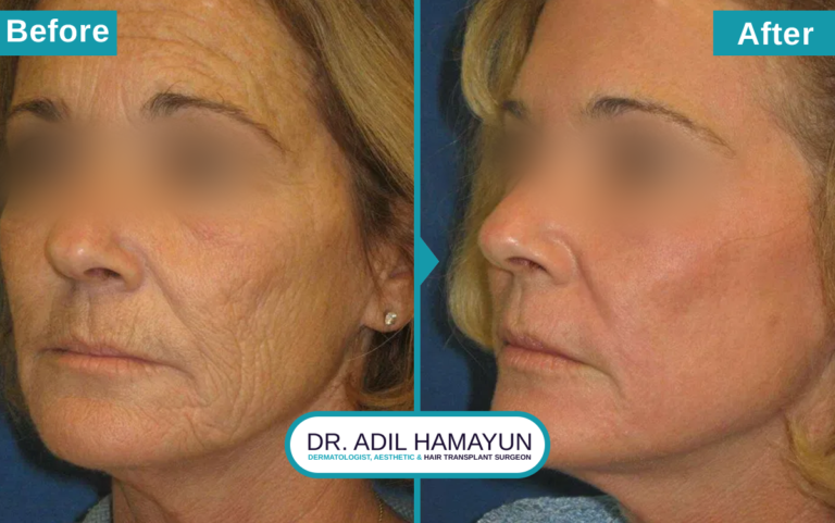 CO2 Laser resurfacing