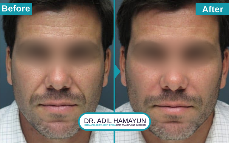 Fillers Treatment in Peshawar