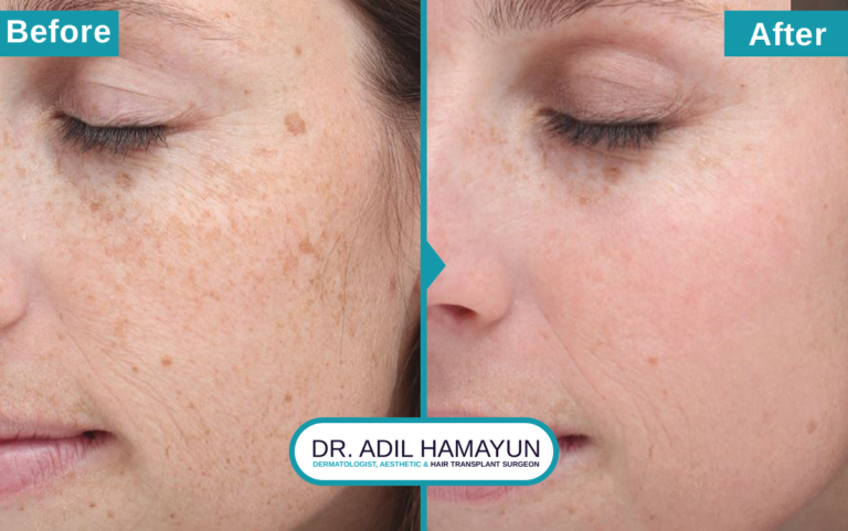 Best Freckle Removal Treatment in Peshawar