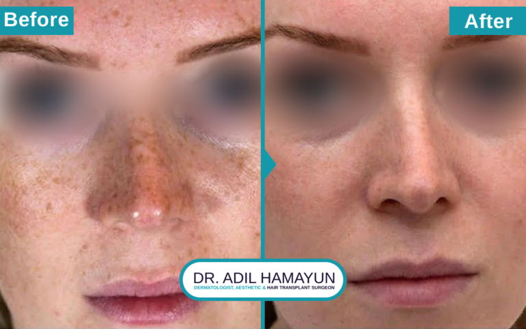 Best Freckle Removal Treatment in Peshawar