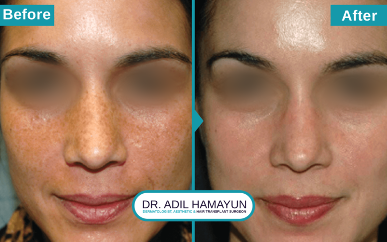 Best Freckle Removal Treatment in Peshawar