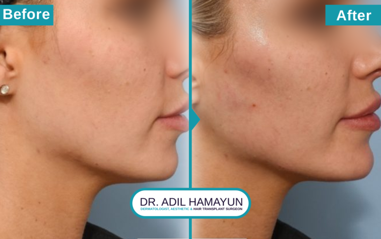 Fillers Treatment in Peshawar