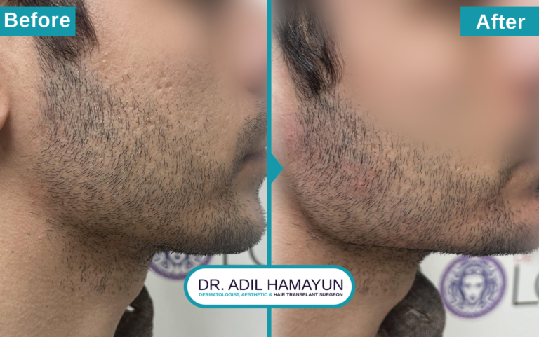 Fillers Treatment in Peshawar