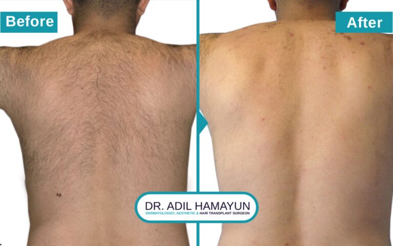 Laser Hair Removal treatment