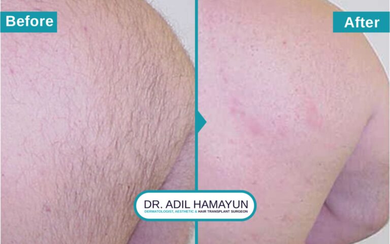 Laser Hair Removal treatment