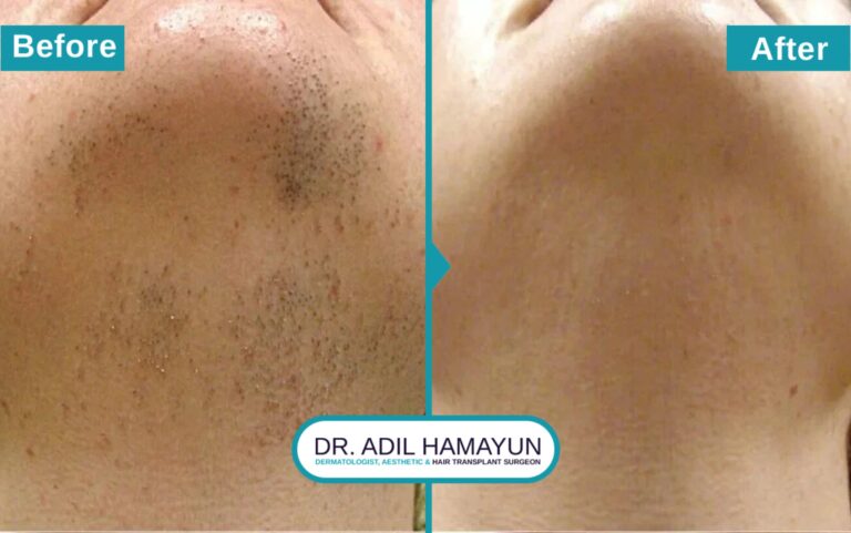 Laser Hair Removal treatment